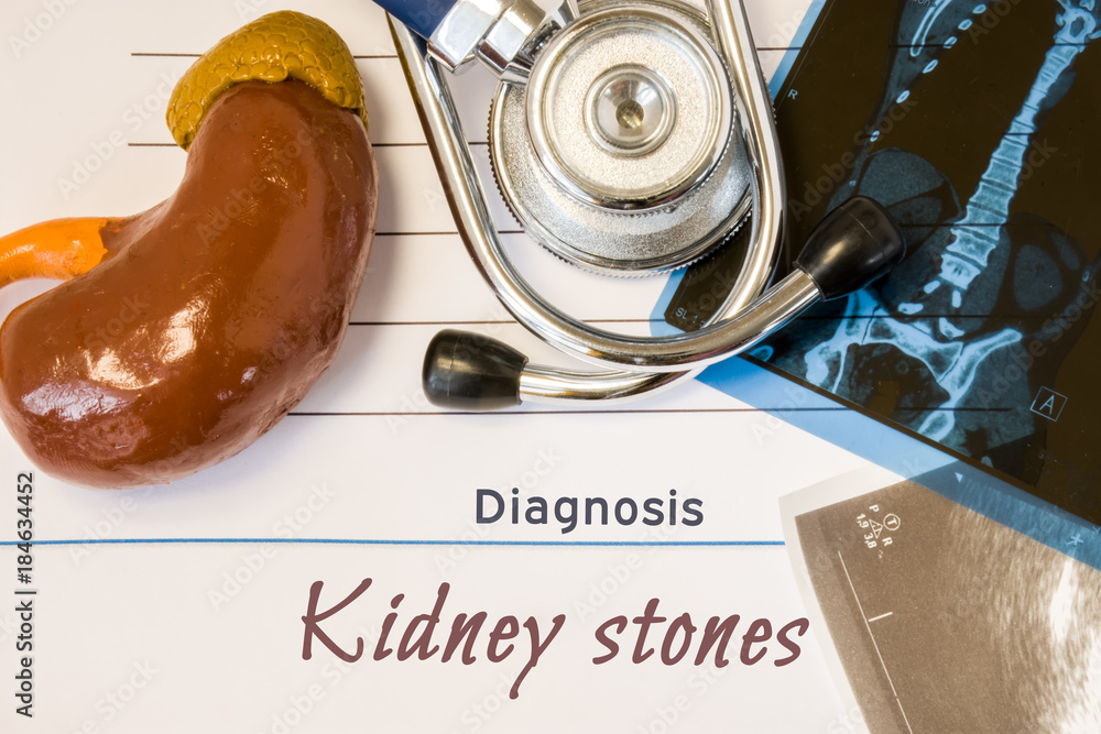 Diagnosis Kidney Stones photo. Figure of kidney lies next to