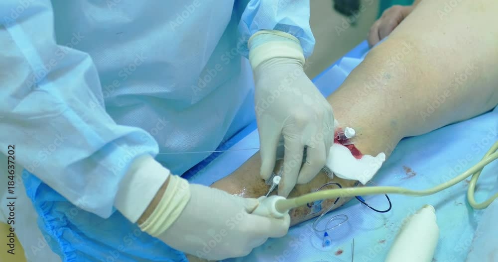 Innovative method of varicose veins surgery, sclerotherapy procedure. Close-up shot of patient legs Innovative method of varicose veins surgery, sclerotherapy procedure. Close-up shot of patient legs