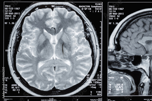 Photo MRI ,MRA,of the brain