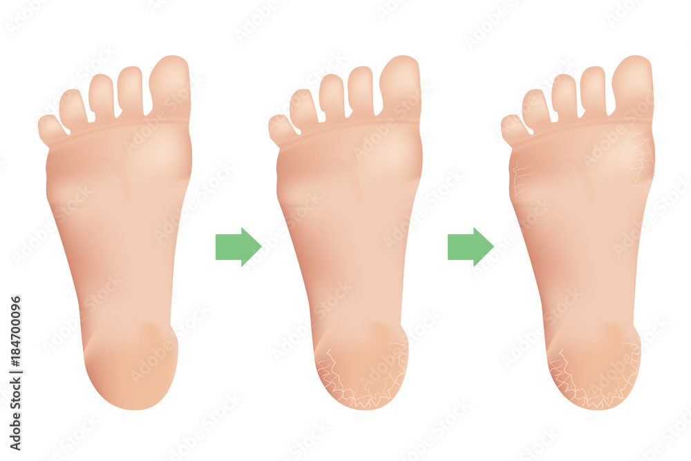 Cracked heels on white background Vector illustration. Cracked heels on white background Vector illustration.