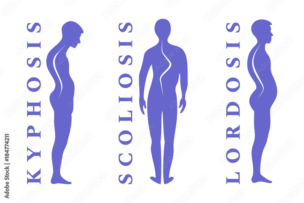 Diseases of the spine. Scoliosis, lordosis, kyphosis. Body posture