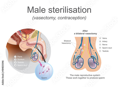 The male reproductive system these work together to produce sperm. Cut or block the tubes so that egg and sperm cannot meet. Illustration.