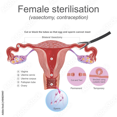 Female sterilisation vasectomy. The male reproductive system these work together to produce sperm.