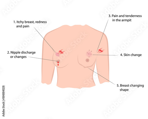 Early symptoms of breast cancer