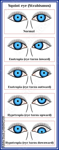 Squint eye (Strabismus). Deflection of visual axes.