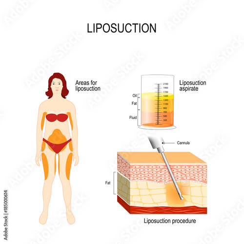 Liposuction process and areas for lipo