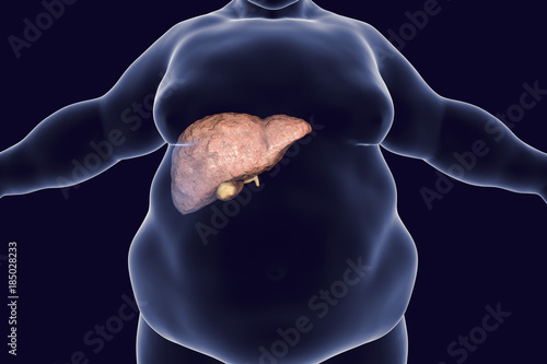 Obese man with fatty liver, 3D illustration. Conceptual image for non-alcoholic fatty liver disease