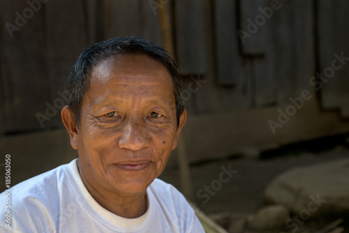 Hmong Amputee