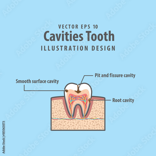 Cavitys tooth cross-section structure inside tooth diagram and chart illustration vector on blue background. Dental concept.