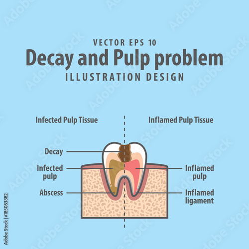 Decay and Pulp problem cross-section structure inside tooth diagram and chart illustration vector on blue background. Dental concept.
