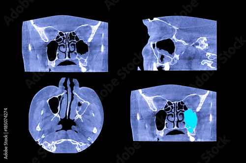Computed tomography of the paranasal sinuses. Triple maxillary sinus. Congenital defects. Chronic rhinosinusitis