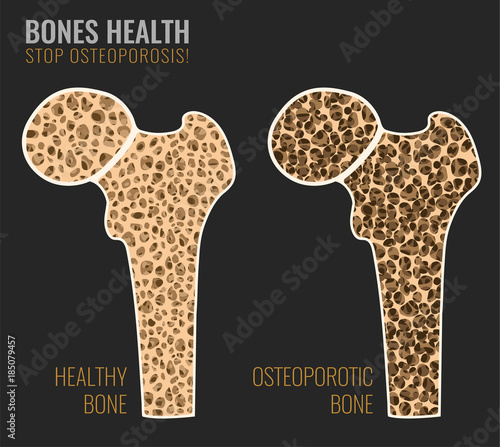 Osteoporosis Bone image photo