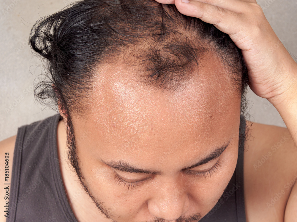 Fototapeta premium closeup of hair lose