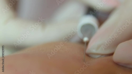 intradermal injections for rejuvenation, closeup photo