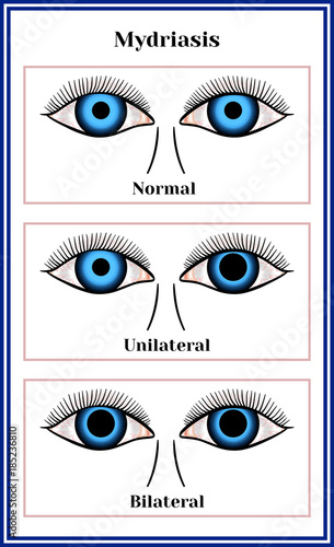 Mydriasis - expansion of a pupil.