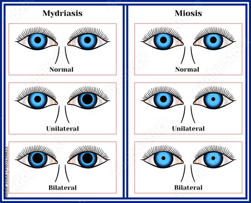 Mydriasis - expansion of a pupil. Miosis - narrowing of a pupil. photo
