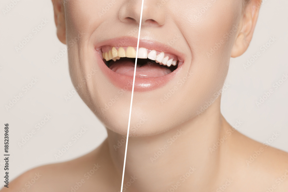 The female teeth before and after whitening.