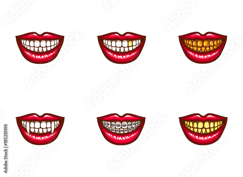 Set of vector red female lips with white healthy teeth and perfect smile, with vampire fangs, with metal dental crowns and implants, with braces. Pop art style illustration. Clipart for dental design