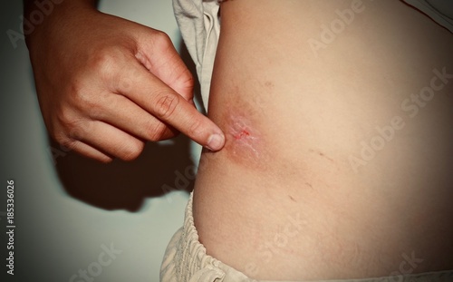 Sores on the body caused by the misbehavior of a boy.