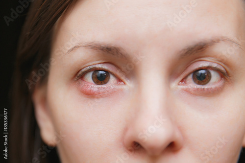 Close up photo of young caucasian brunette woman barley brown eye infection, eyelid abscess, stye, hordeolum. Concept of health, disease and treatment. photo