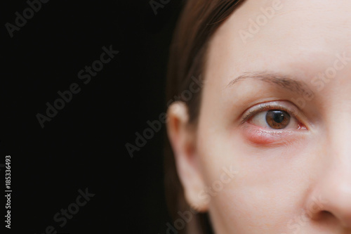 Close up of young caucasian brunette woman barley brown one eye infection, eyelid abscess, stye, hordeolum. Concept of health, disease and treatment. Copy space for advertisement. With place for text.