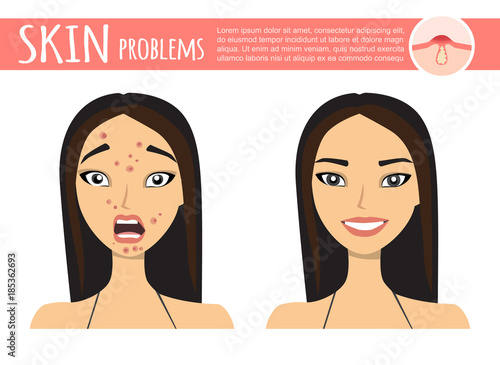 acne treatment before after, facial cleansing foam, cartoon illustration