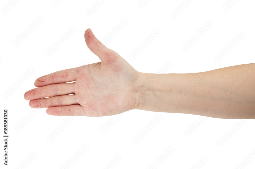 Female hand with dermatitis