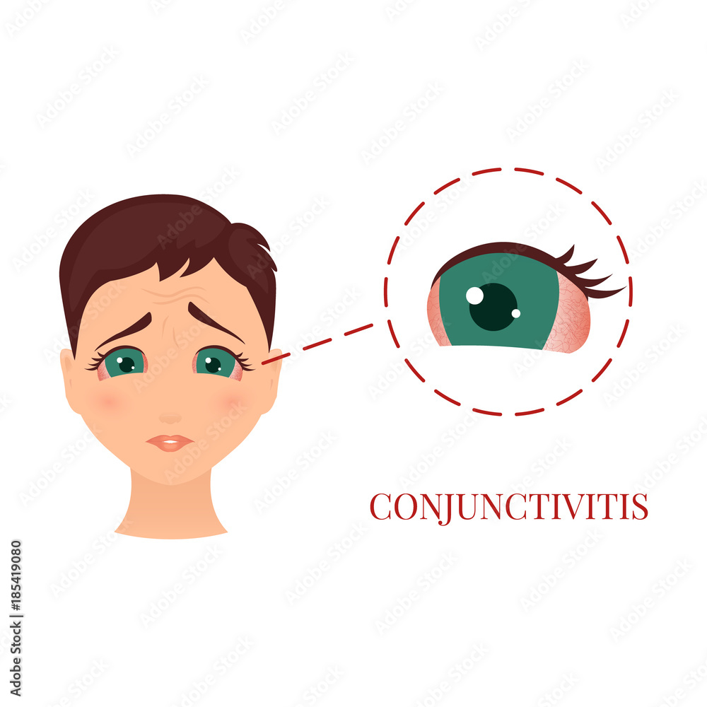 Fototapeta premium Woman with conjunctivitis. Closeup view. Patient with pinkeye. Infectious viral disease. Medical concept. Anatomy of people. Vector illustration. 