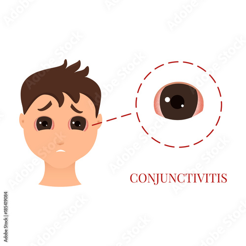 Man with conjunctivitis. Closeup view. Sad patient with pinkeye. Infectious viral disease. Medical concept. Anatomy of people. Vector illustration.
