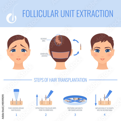 Female hair loss FUE medical treatment. Stages of follicular unit extraction procedure. Female alopecia infographic vector design template for transplantation clinics and diagnostic centers. 
