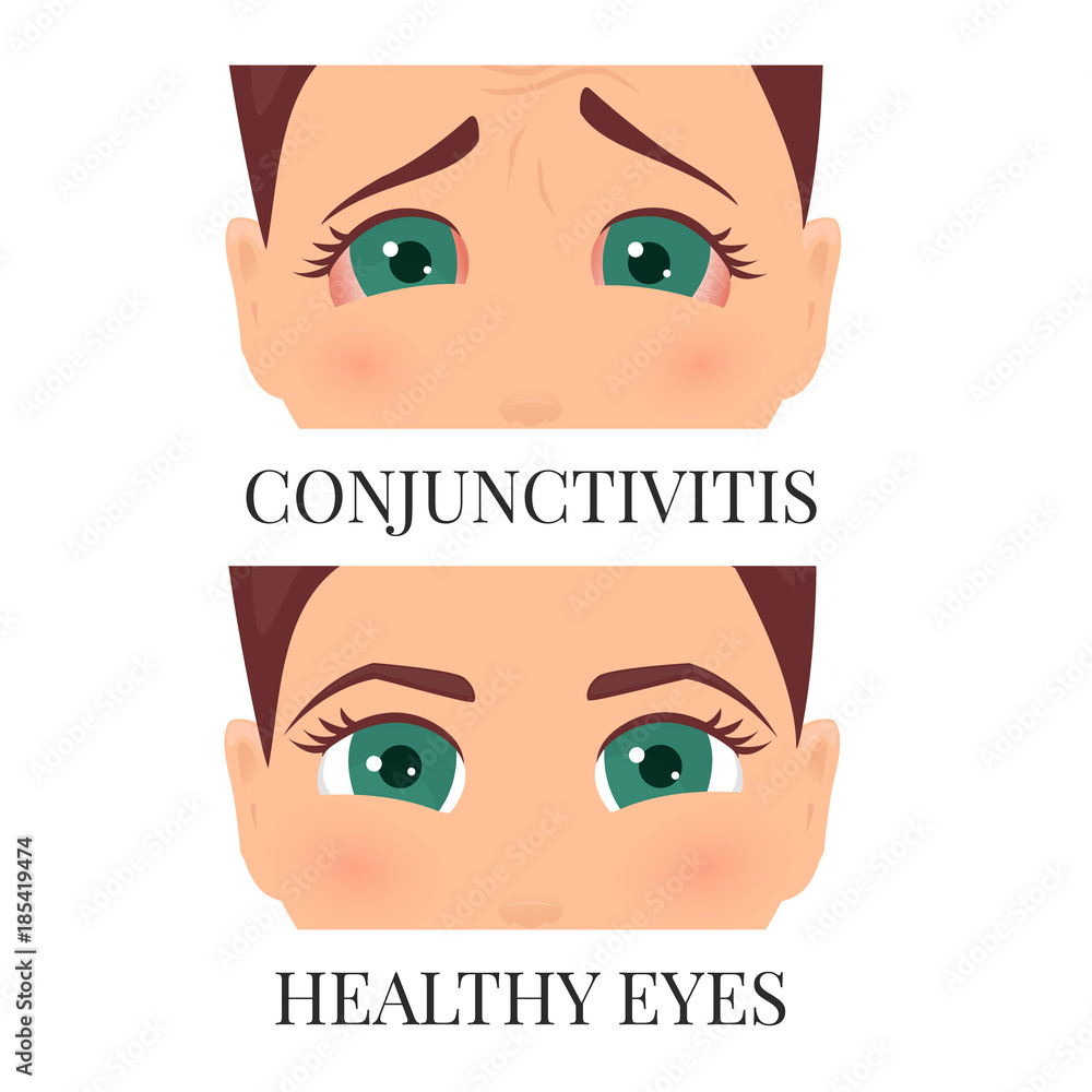 Fototapeta premium Woman with conjunctivitis. Closeup view. Patient with pinkeye. Infectious viral disease. Medical concept. Anatomy of people. Vertical vector illustration. 
