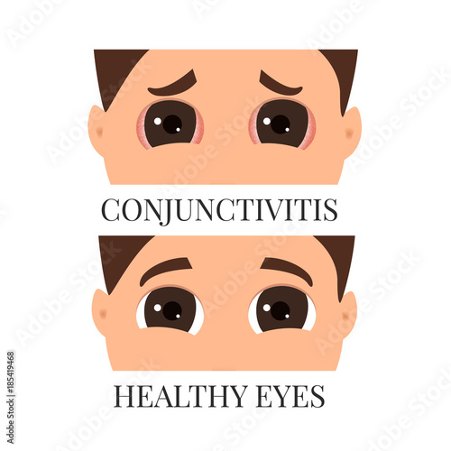 Man with conjunctivitis. Closeup view. Sad patient with pinkeye. Infectious viral disease. Medical concept. Anatomy of people. Vertical vector illustration.
