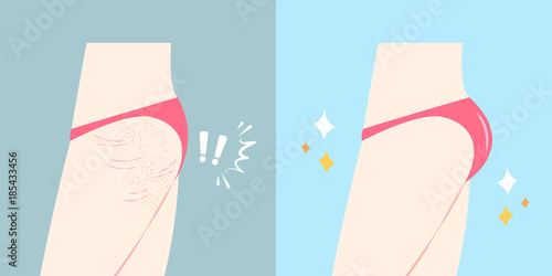 buttocks with plastic surgery concept