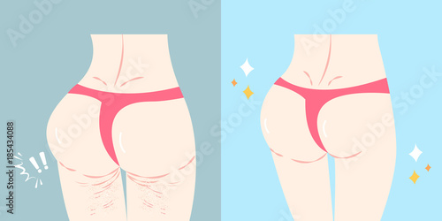 buttocks with plastic surgery concept