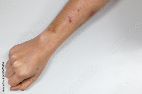 Atopic dermatitis (AD), of inflammation of the skin (dermatitis).