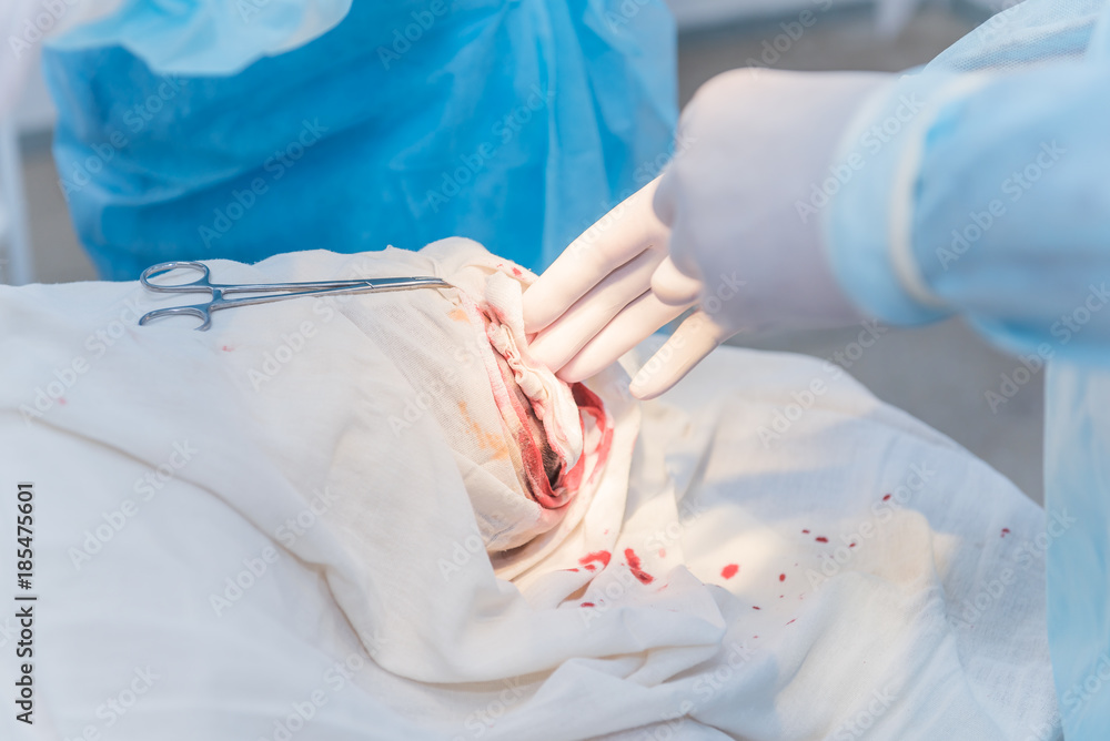 Fototapeta premium the hands of a surgeon's doctor doing operations on a remote atheroma on the patient's head in a hospital