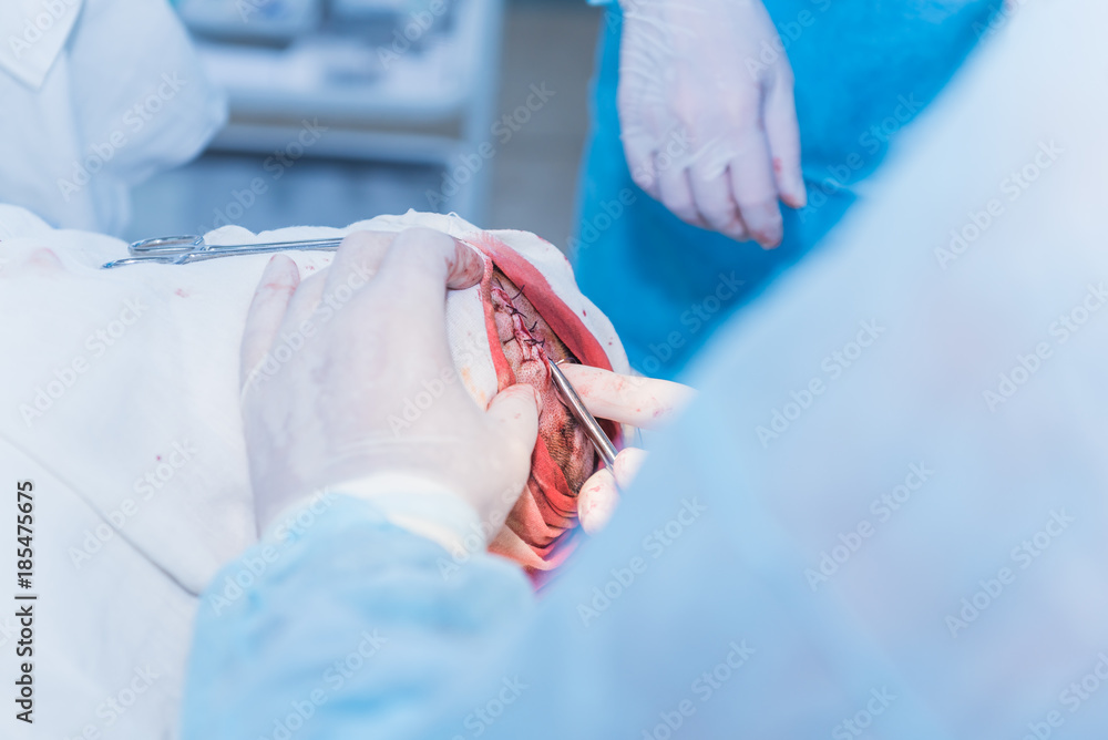Fototapeta premium the hands of a surgeon's doctor sewing up the cut of the skin after an operation to remove the atheroma on the patient's head in the hospital. concept photo of professional doctors, painless medicine