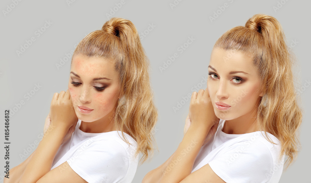 Acne.Post-Acne Marks /Treating Acne Scars Acne.Post-Acne Marks /Treating Acne Scars