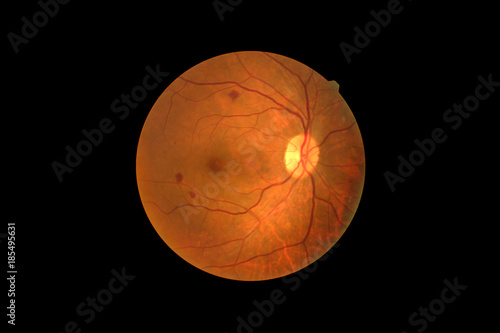 Photo Madical Retina Abnormal isolated on black background.Retina of diabetes   diabates retinopathy. photo