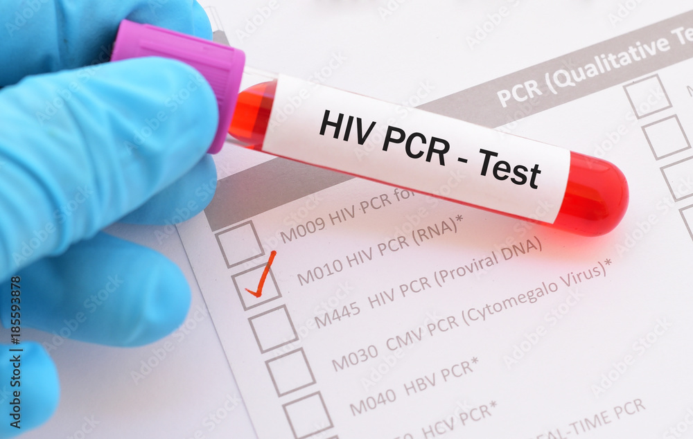 Blood sample for HIV PCR test Stock Photo Adobe Stock