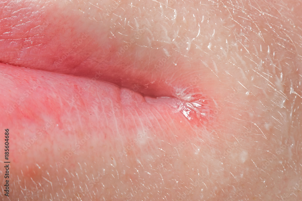Fototapeta premium Wound on the lips, macro