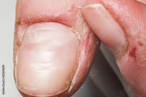 Damaged skin on the finger, burrs, macro