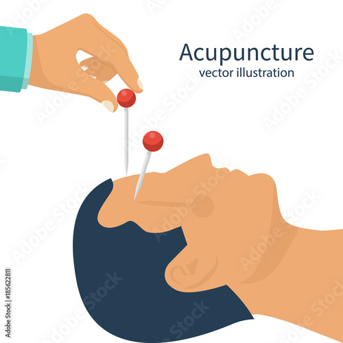 Acupuncture treatment closeup. Salon spa center. Needle in hand. Prick patient's head. Vector illustration flat design. Isolated on white background. Alternative medicine. Healthcare concept.
