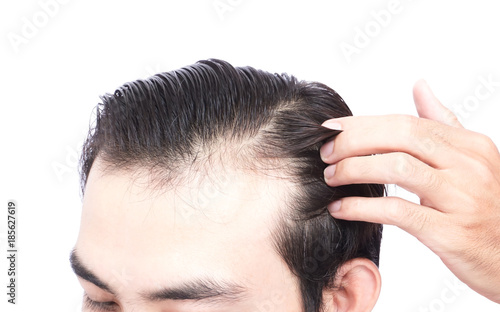 Young man serious hair loss problem for health care medical and shampoo product concept