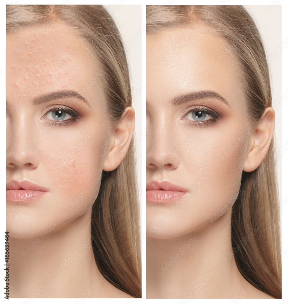 Woman before and after treatment Woman before and after treatment