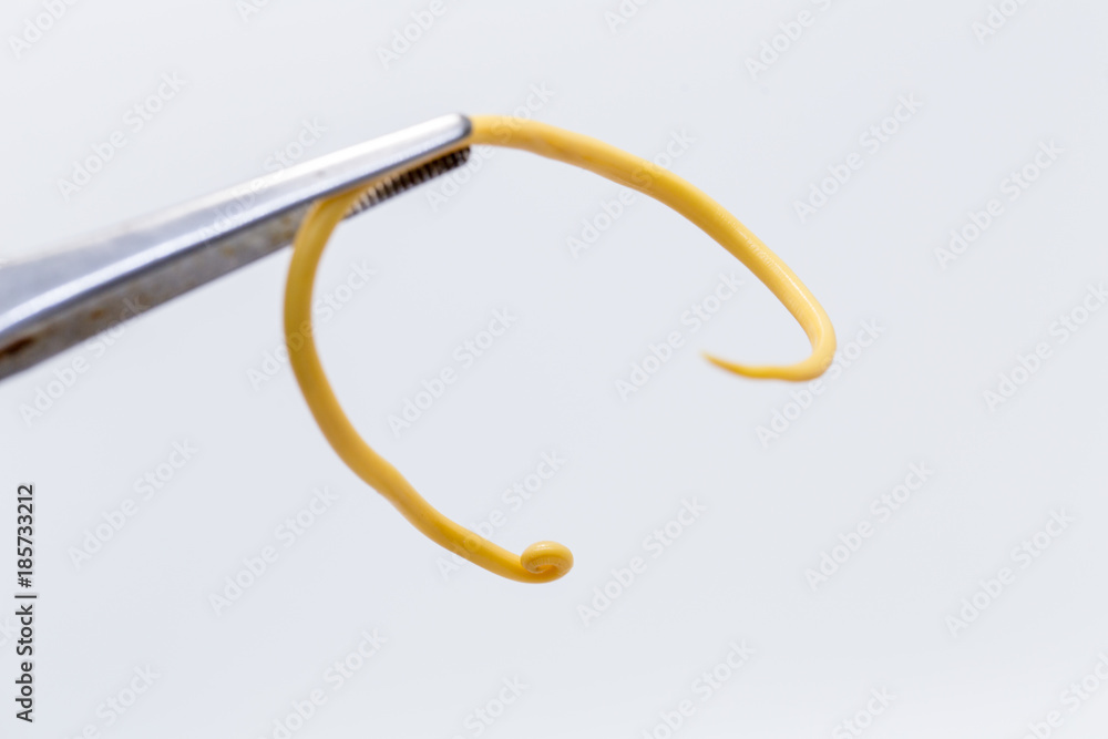 Ascariasis is a disease caused by the parasitic roundworm Ascaris ...