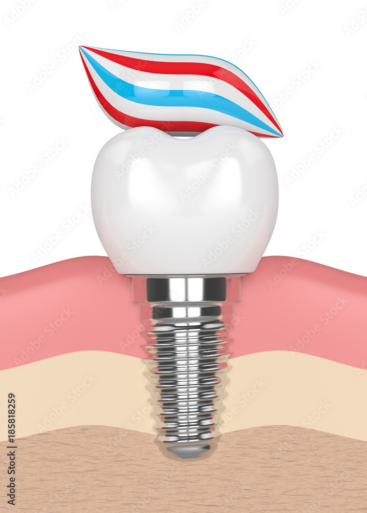 3d render of dental implant with toothpaste 3d render of dental implant with toothpaste