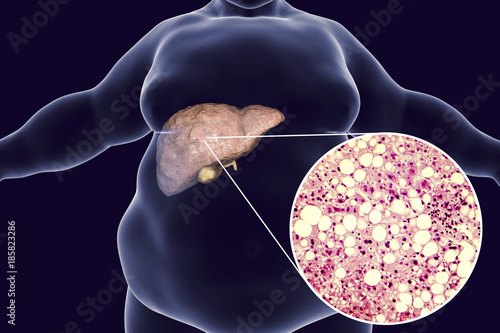 Obese man with fatty liver, 3D illustration and photomicrograph of liver steatosis. Conceptual image for non-alcoholic fatty liver disease photo
