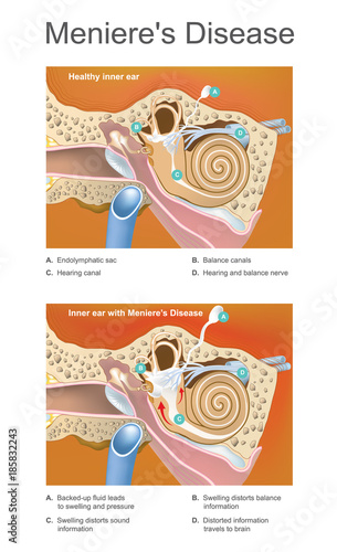 Meniere disease. Illustration. Disorder of the inner ear that can effect hearing and balance to a varying degree. photo