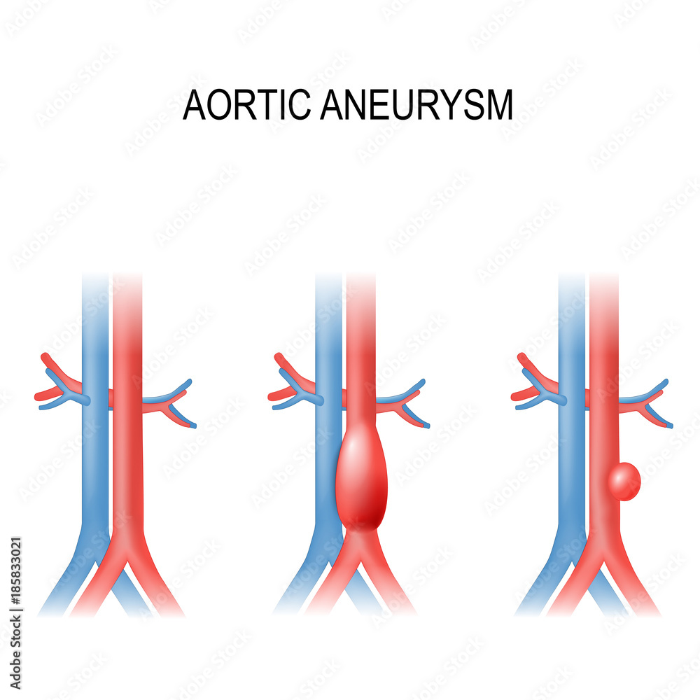 abdominal aortic aneurysm abdominal aortic aneurysm